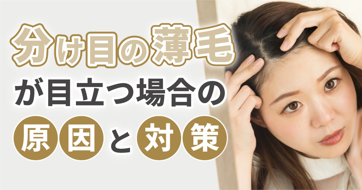 分け目の薄毛が目立つ場合の原因と対策