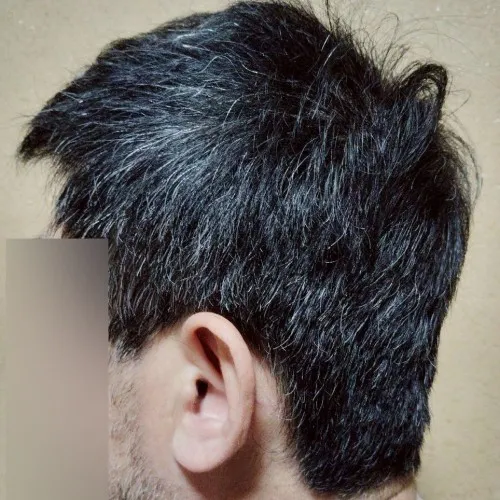 レバクリでAGA治療をおこなったKさん