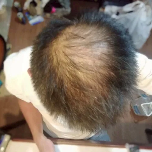 レバクリでAGA治療を開始する前のKさん