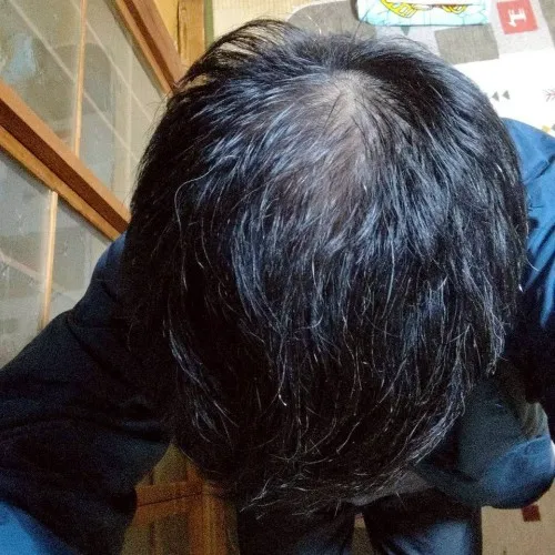 レバクリでAGA治療を開始してから6ヶ月後のKさん